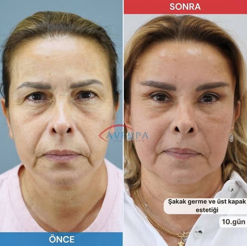 3 Badem göz estetiği