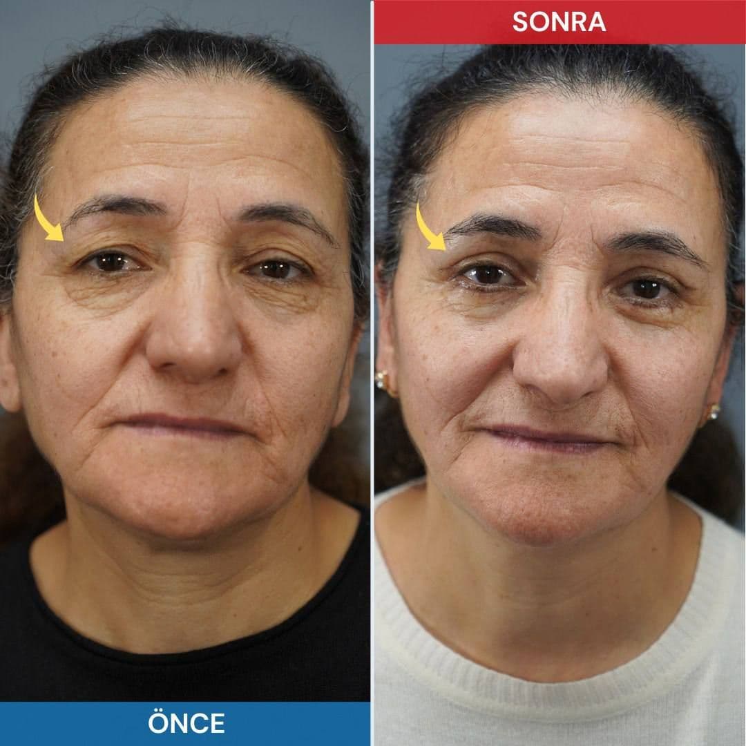 badem göz