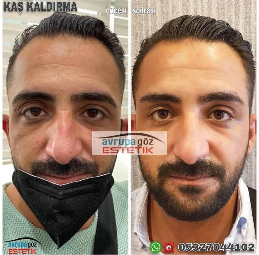 bu bir goz kapagi estetigidir